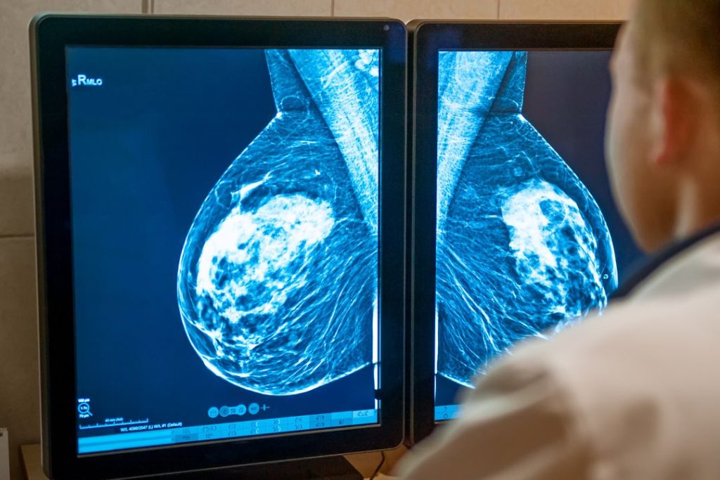 BIRADS 5 Aún puede no ser Cáncer