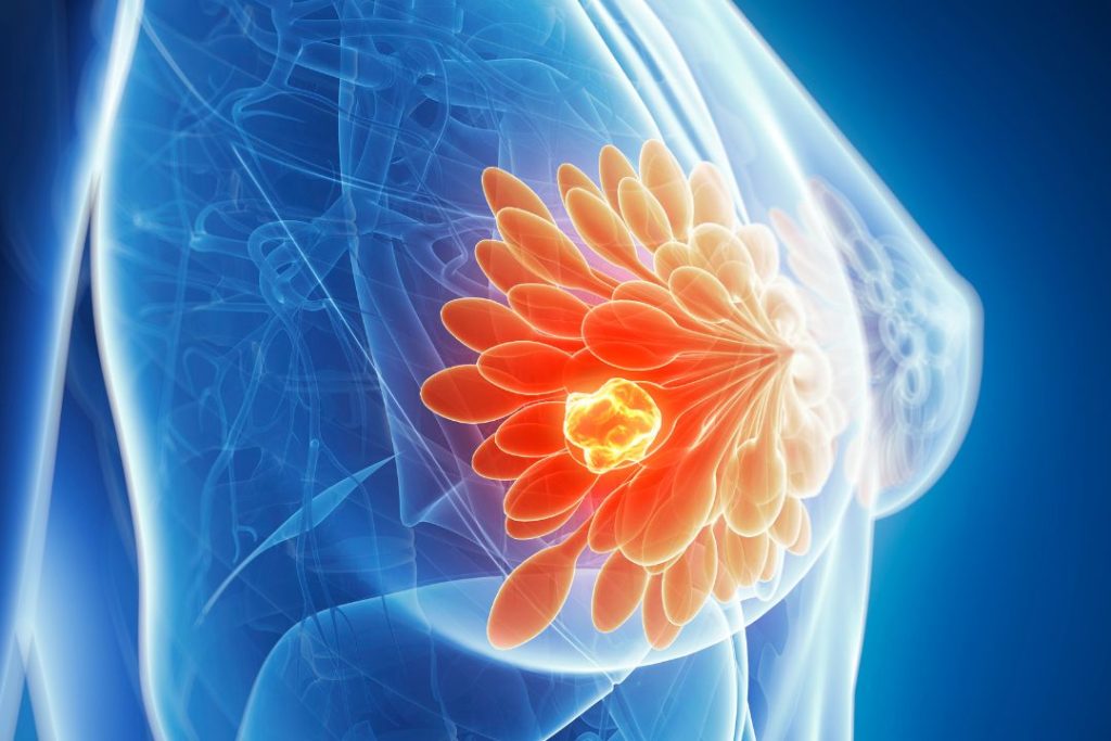 BIRADS 5 Aún puede no ser Cáncer