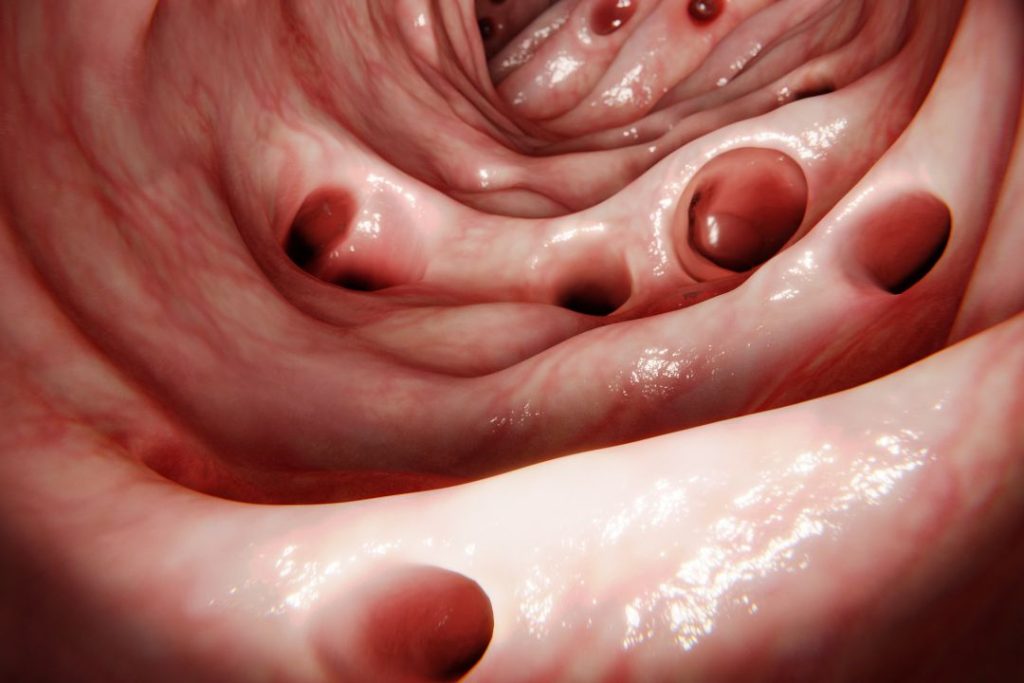 Colonoscopia: Cómo se Hace