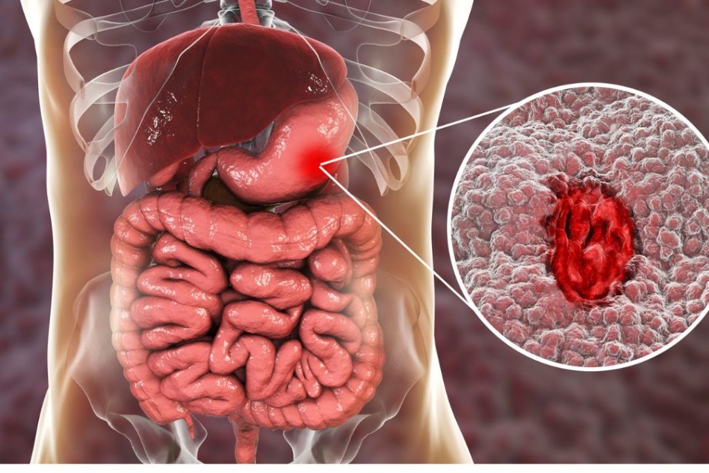 Gastroenterólogo Qué es, qué enfermedades trata y cuándo consultar