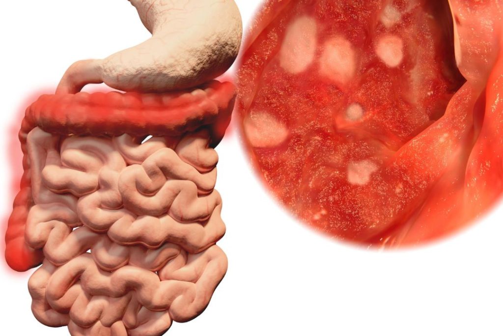 Hematoquecia: Qué es
