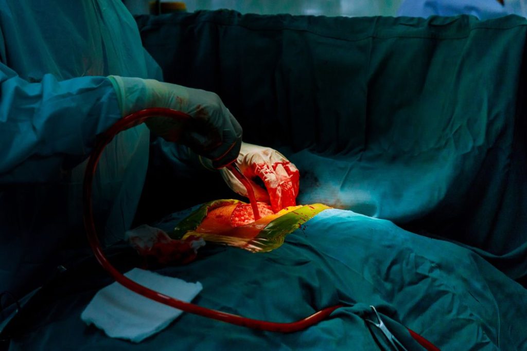 Hemorragia interna abdominal por traumatismo