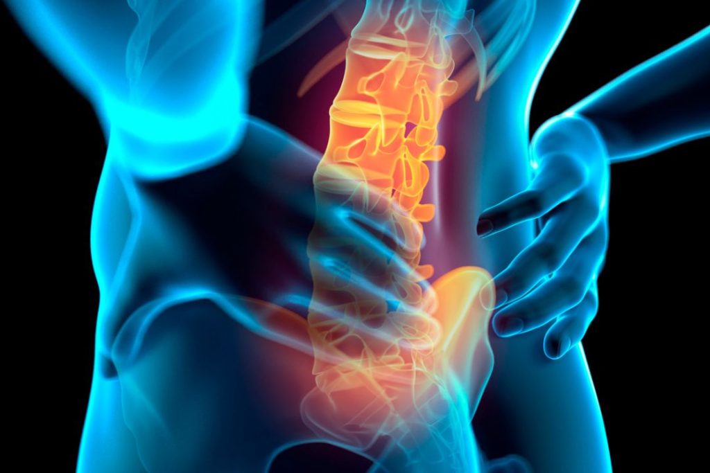 Hiperlordosis lumbar en mujeres cómo afecta y qué hacer1