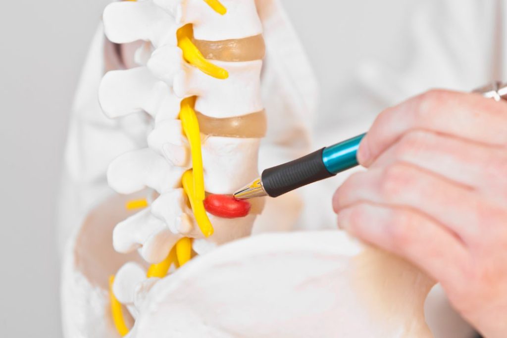 Hiperlordosis lumbar en mujeres cómo afecta y qué hacer1