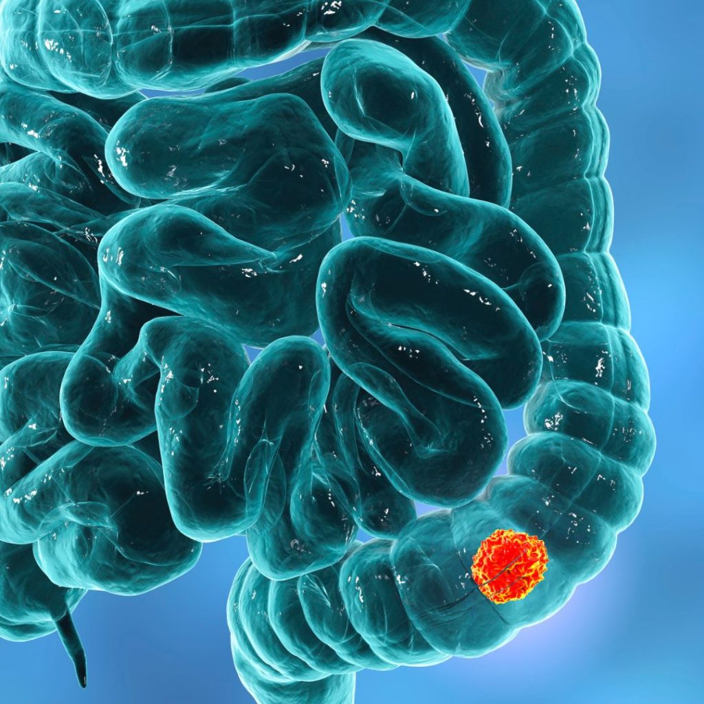 Qué son los pólipos en el colon