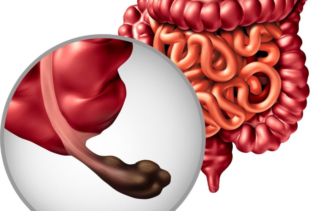Síntomas de apendicitis en mujeres