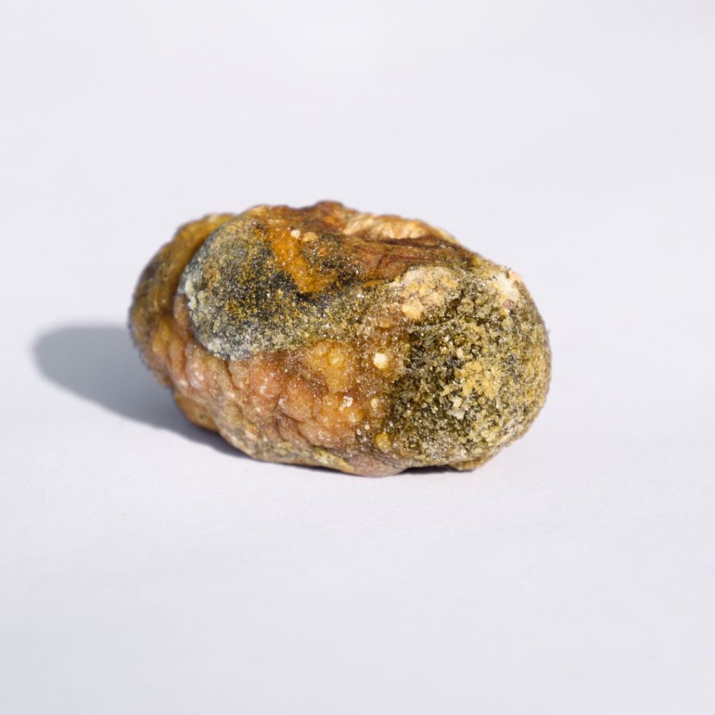 Tratamiento para las piedras en la vesícula