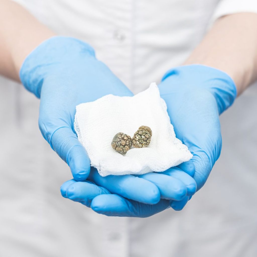 Tratamiento para las piedras en la vesícula