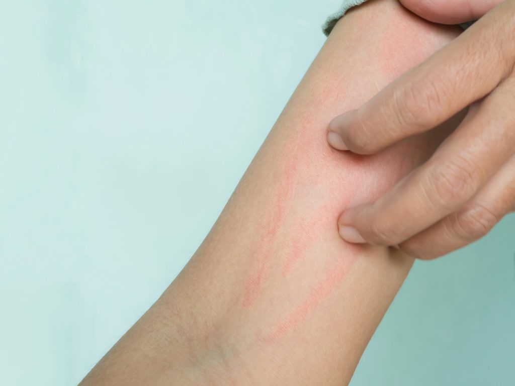 Hand with Urticaria Allergy Itchy Rash Eczema Itch Woman