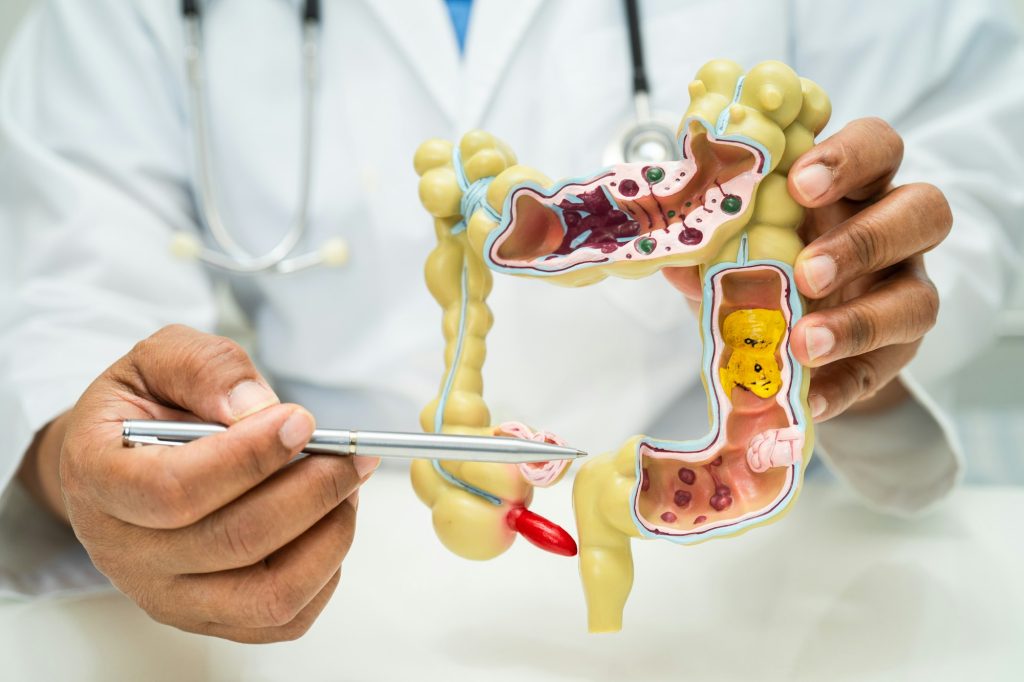 Qué son los pólipos en el colon
