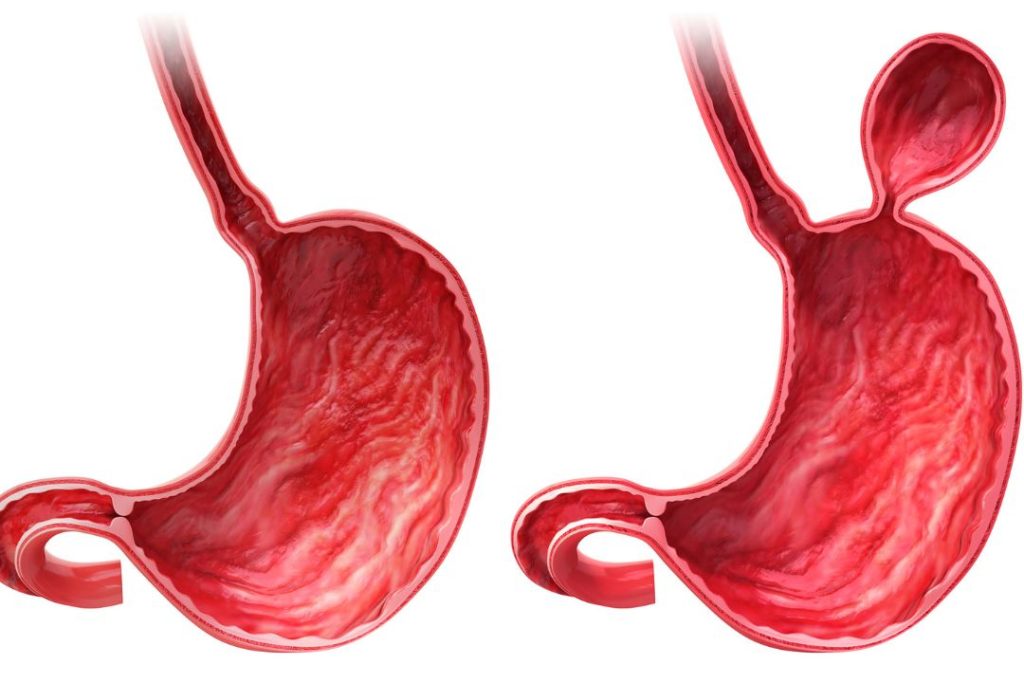 ¿Cuánto cuesta una operación de hernia en Panamá?