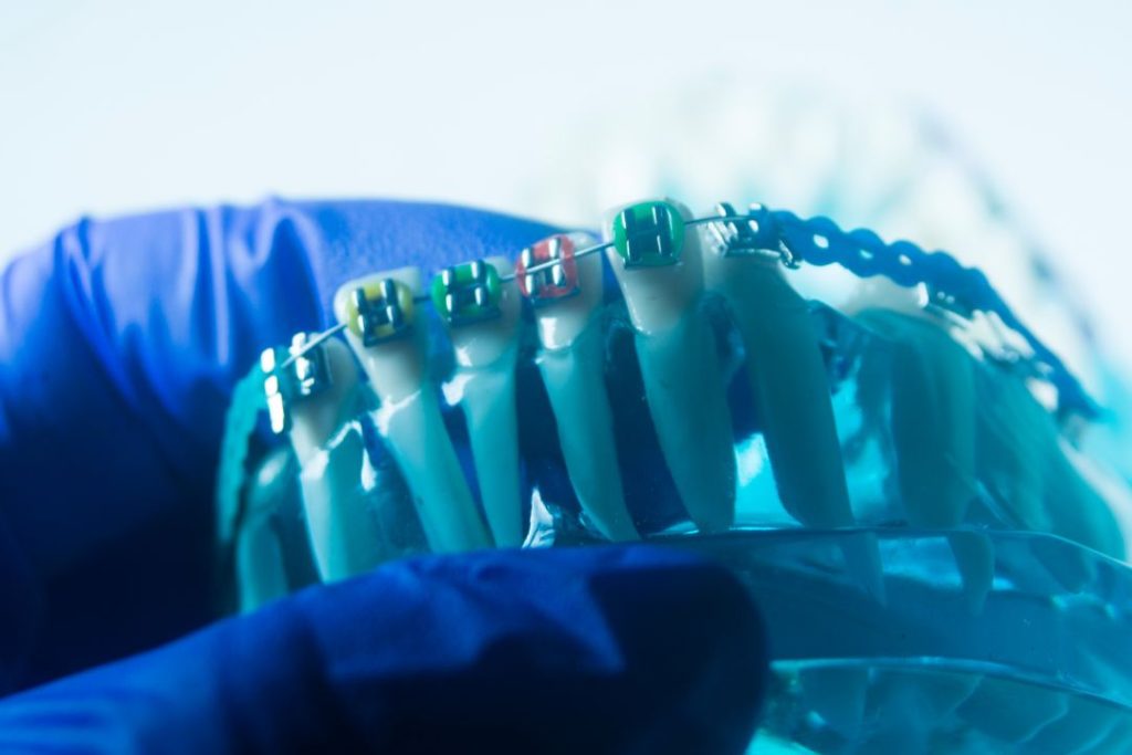 Cuánto cuesta ponerse brackets en Panamá