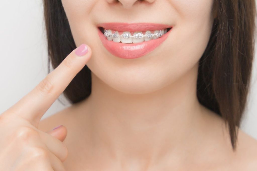 Cuánto cuesta ponerse brackets en Panamá