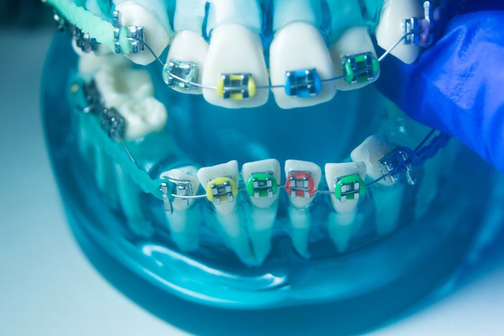 Cuánto cuesta ponerse brackets en Panamá