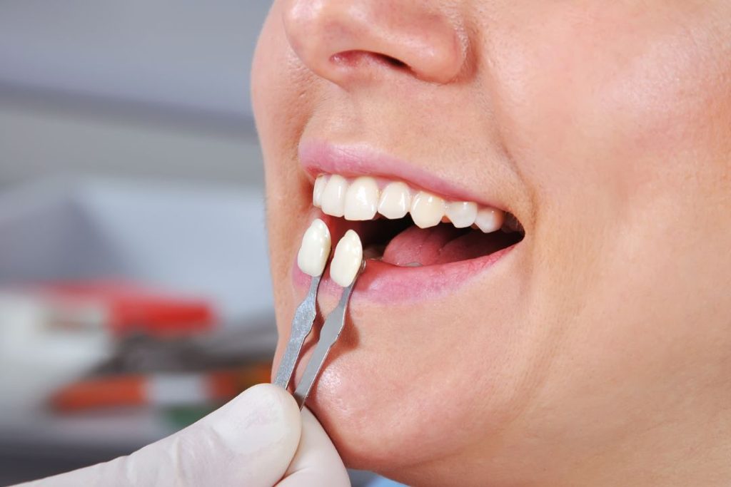 Cuánto cuesta una corona dental en Panamá