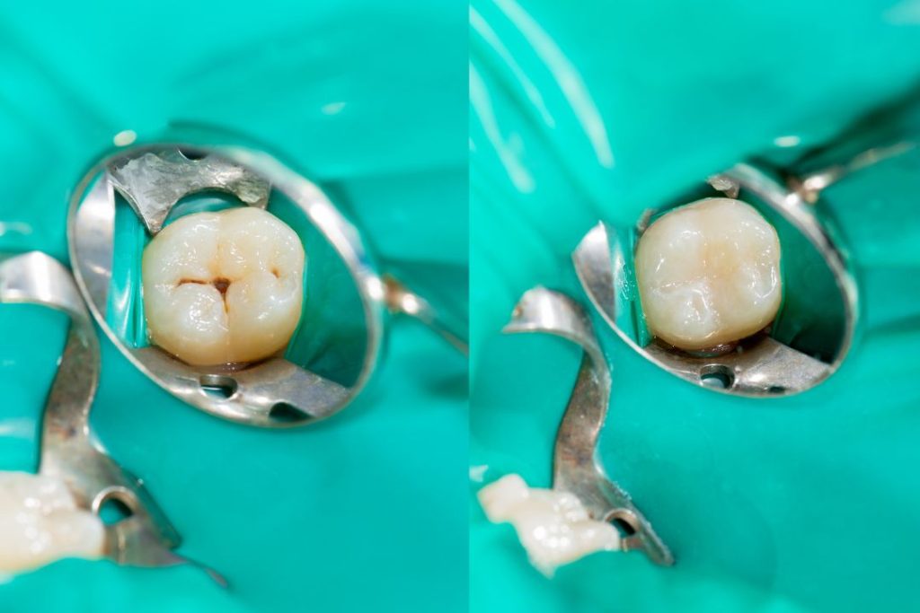 Qué precio tiene una endodoncia en Panamá (1)