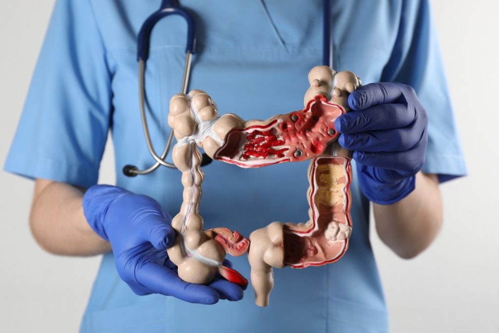 Síntomas de colitis en mujeres Causas y Tratamiento
