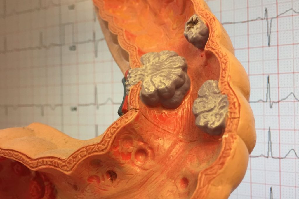 Dieta para diverticulitis 